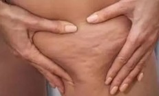 脂肪团怎么消除？只需要Skinova美容仪，一键去除它