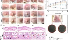超声对痘痘炎症有效的佐证论文