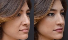 抬头纹怎么去除？Skinova美容仪是法令纹去除最好的方法